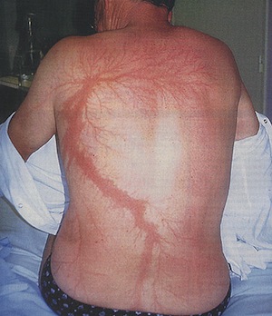 После удара молнии на теле человека появляются фигуры Лихтенберга — «цветы молнии»